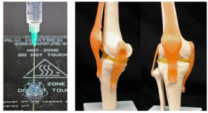 knee joints